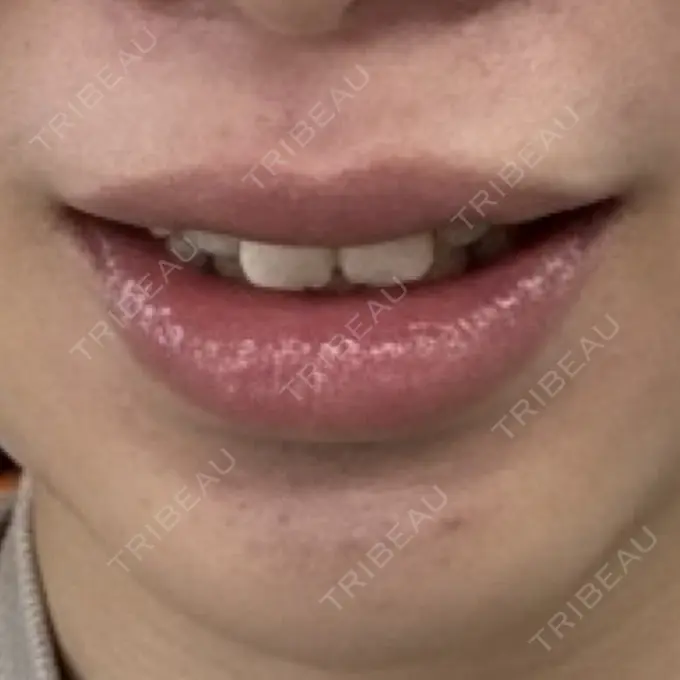 医療脱毛（顔） 日本美容・医療クリニック 六本木院 AFTER メイン用