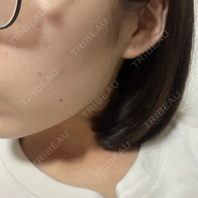 ピーリング（ニキビ・毛穴） 大美会クリニック 岡山院 DAY 2 メイン用