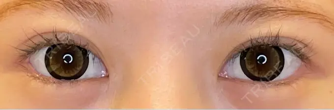 目尻切開 / タレ目形成・グラマラスライン（埋没） LOUIS CLINIC 二子玉川院【ルイクリニック】 AFTER メイン用