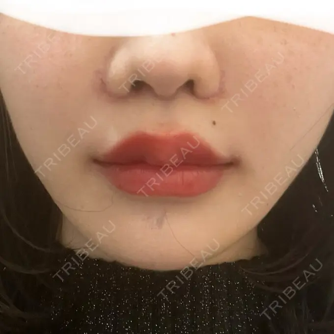 人中短縮 東京美容医療クリニック 池袋院 DAY 8 メイン用