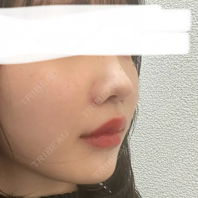 人中短縮 東京美容医療クリニック 池袋院 DAY 8 メイン用