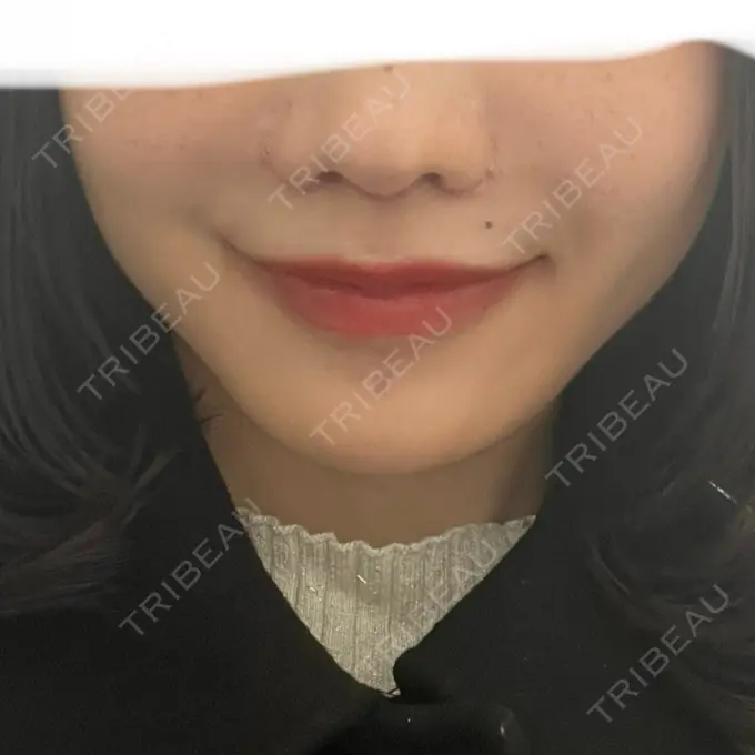 人中短縮 東京美容医療クリニック 池袋院 DAY 15 メイン用