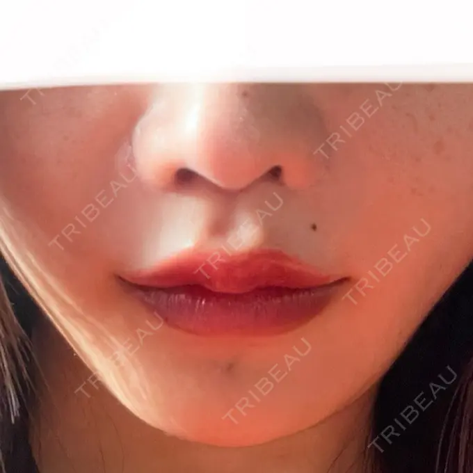 人中短縮 東京美容医療クリニック 池袋院 AFTER メイン用