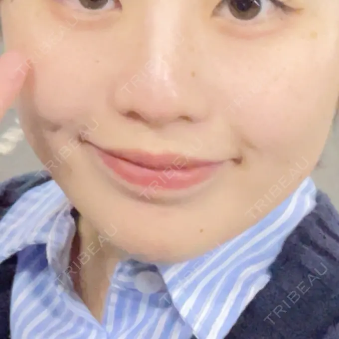 光治療（フォトフェイシャルなど） トラスト美容クリニック 銀座院 DAY 8 メイン用