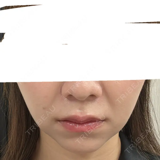 糸リフト / 脂肪吸引（顔） / ほくろ・いぼ除去レーザー（肌） 横浜TAクリニック AFTER メイン用