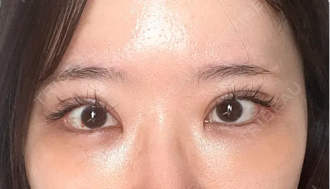 クマ治療 / 下まぶたの脂肪取り / 脂肪注入（目の下） ルラ美容クリニック 渋谷本院 DAY 9 メイン用