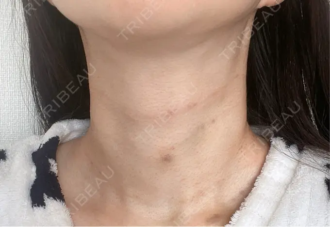 ヒアルロン酸注入（首） 銀座TSUBAKIクリニック DAY 2 メイン用