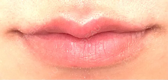 ヒアルロン酸注入（唇） 目白ホワイトクリニック AFTER メイン用