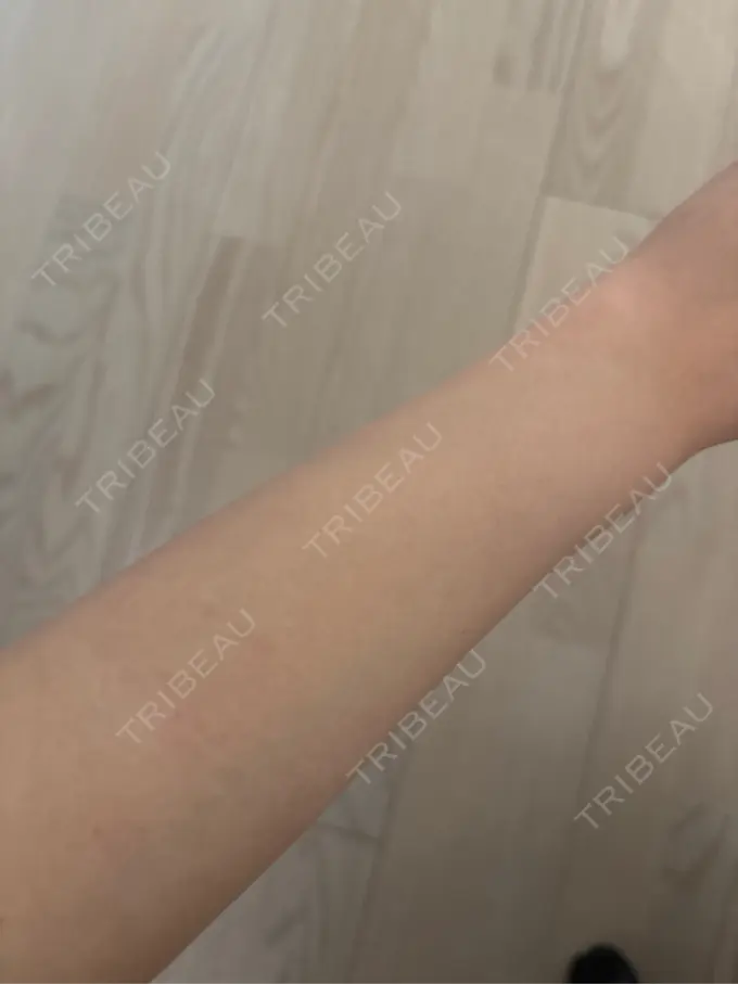 医療脱毛（全身） ダビデクリニック渋谷 AFTER メイン用