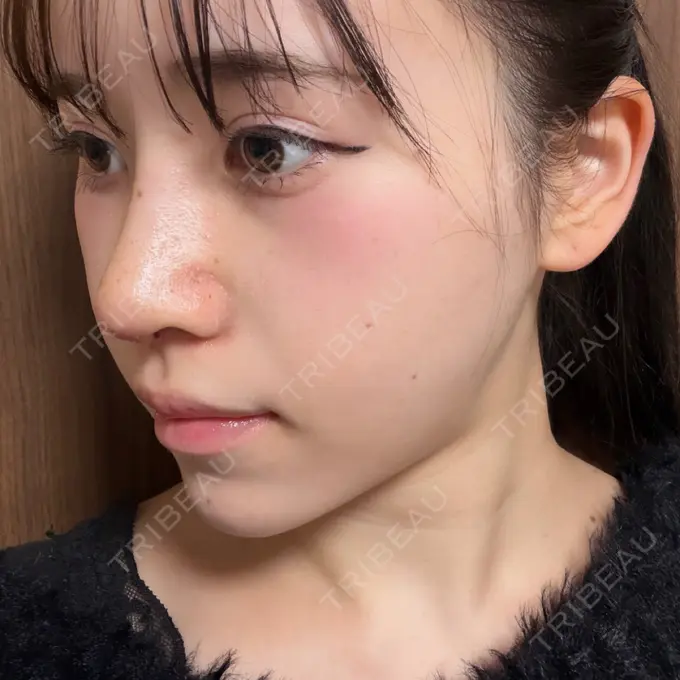 隆鼻術 / 軟骨移植 / 鼻尖形成（非切開） / 鼻中隔延長（非切開） WOM CLINIC GINZA （ワム クリニック ギンザ） DAY 8 メイン用