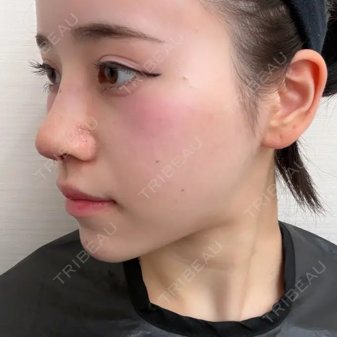 隆鼻術 / 軟骨移植 / 鼻尖形成（非切開） / 鼻中隔延長（非切開） WOM CLINIC GINZA （ワム クリニック ギンザ） DAY 8 メイン用