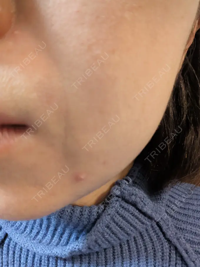 肌育注射（ジュベルックなど） ゆきスキンクリニック 東池袋 DAY 6 メイン用