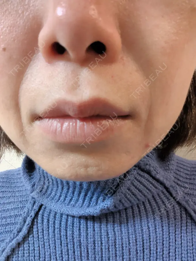 肌育注射（ジュベルックなど） ゆきスキンクリニック 東池袋 DAY 6 メイン用