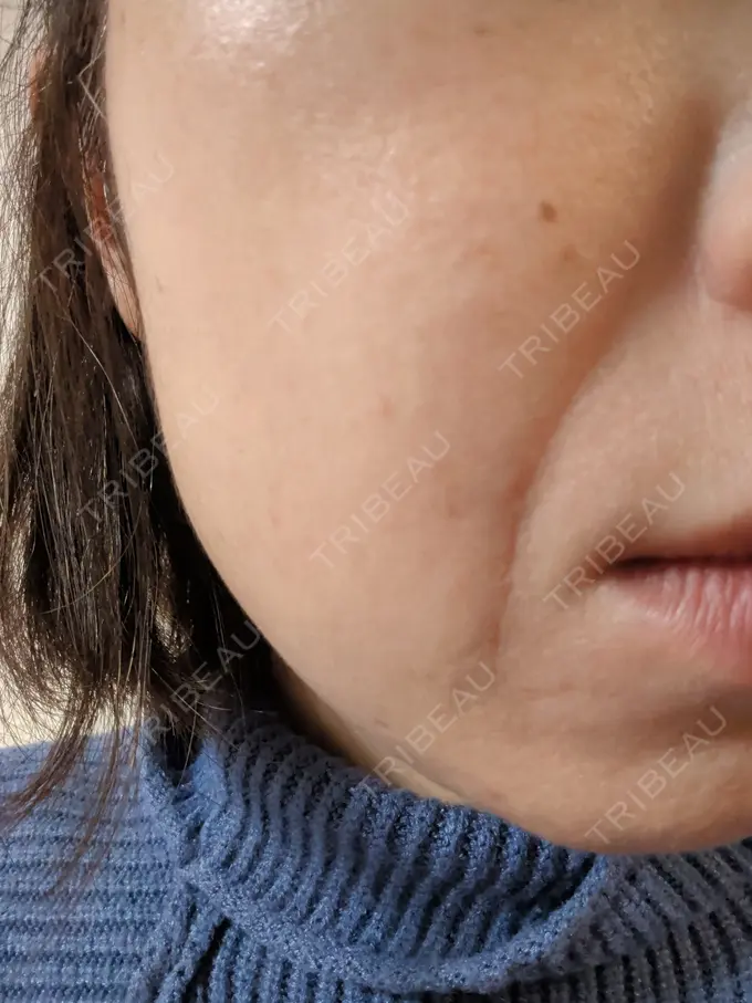 肌育注射（ジュベルックなど） ゆきスキンクリニック 東池袋 DAY 6 メイン用