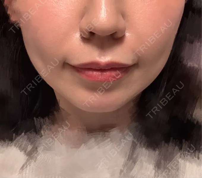 ヒアルロン酸注入（鼻翼基部） Brandnew Beauty Clinic DAY 6 メイン用