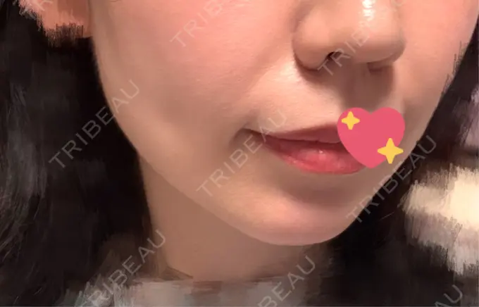 ヒアルロン酸注入（鼻翼基部） Brandnew Beauty Clinic DAY 6 メイン用