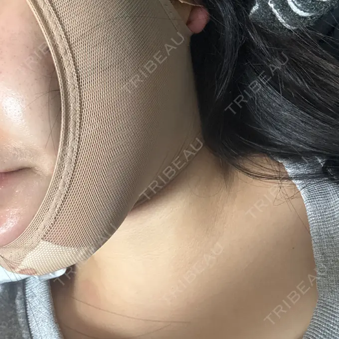 糸リフト / バッカルファット除去 / 脂肪吸引（顔） / ボトックス（エラ・小顔） アリエル美容クリニック 横浜院 DAY 0 メイン用