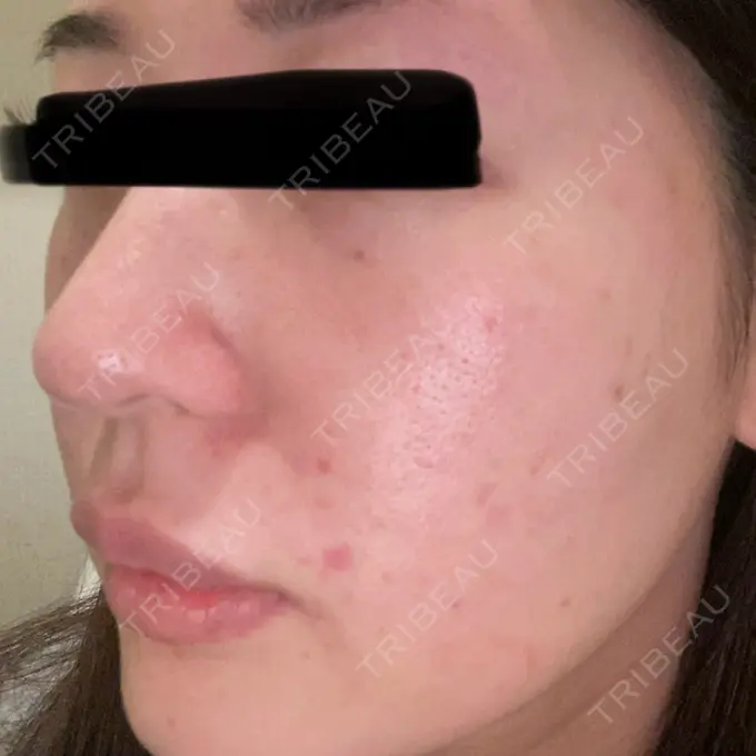 ボトックス（眉間） / ボトックス（額） / エレクトロポレーション / 光治療（フォトフェイシャルなど） / ルメッカ BITO BEAUTY CLINIC AFTER メイン用