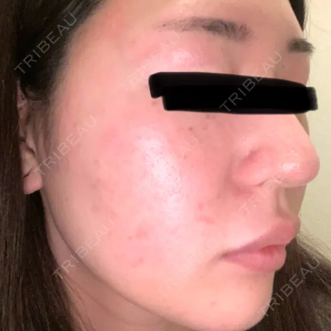 ボトックス（眉間） / ボトックス（額） / エレクトロポレーション / 光治療（フォトフェイシャルなど） / ルメッカ BITO BEAUTY CLINIC DAY 4 メイン用