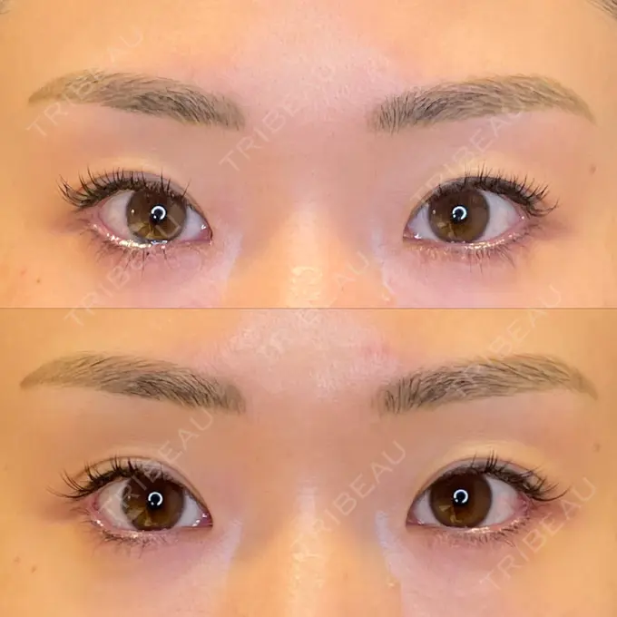 目尻切開 / タレ目形成・グラマラスライン（埋没） LOUIS CLINIC 二子玉川院【ルイクリニック】 AFTER メイン用