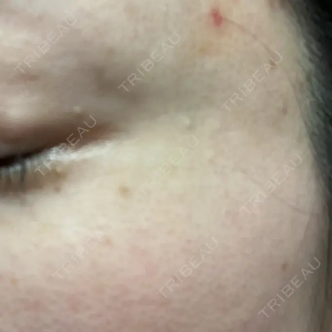 ほくろ・いぼ切除（肌） ルラ美容クリニック 東京駅前院 DAY 2 メイン用