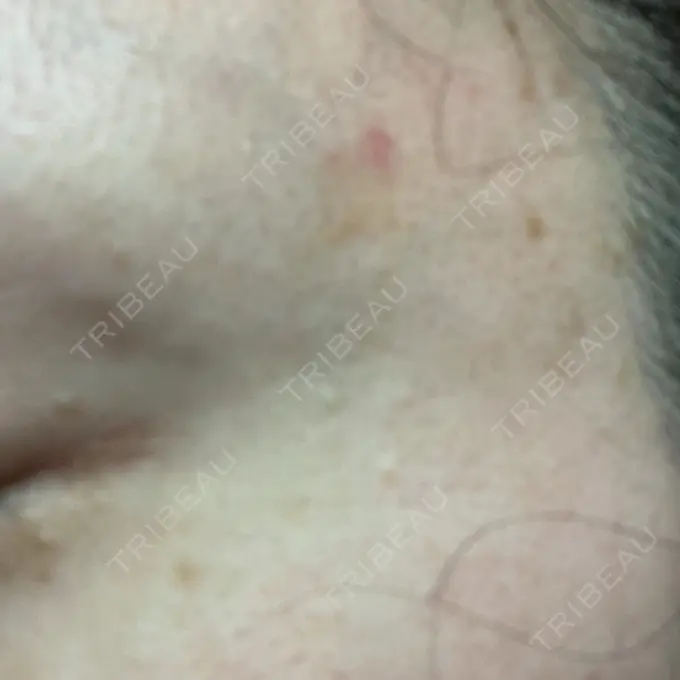 ほくろ・いぼ切除（肌） ルラ美容クリニック 東京駅前院 DAY 4 メイン用