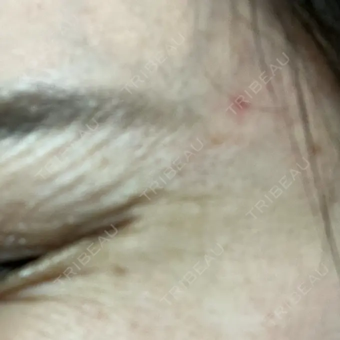 ほくろ・いぼ切除（肌） ルラ美容クリニック 東京駅前院 DAY 6 メイン用