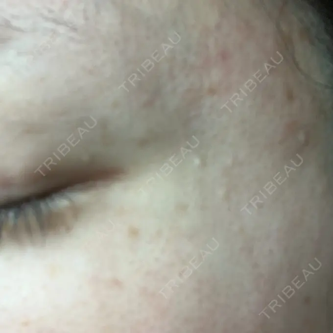 ほくろ・いぼ切除（肌） ルラ美容クリニック 東京駅前院 DAY 9 メイン用