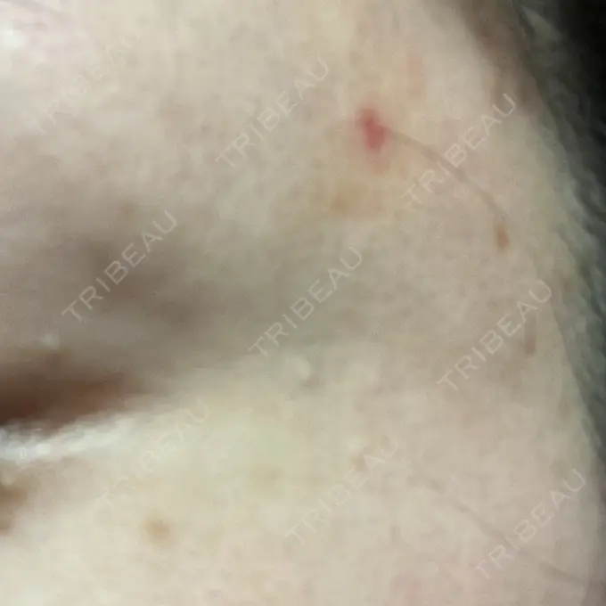 ほくろ・いぼ切除（肌） ルラ美容クリニック 東京駅前院 DAY 3 メイン用