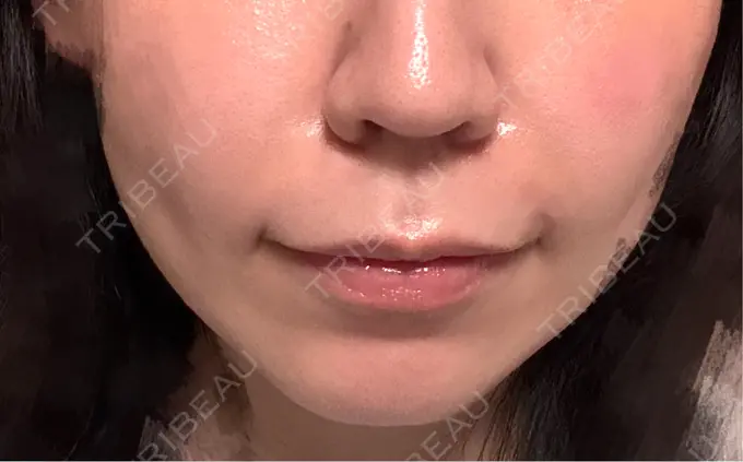ヒアルロン酸注入（鼻翼基部） Brandnew Beauty Clinic DAY 7 メイン用