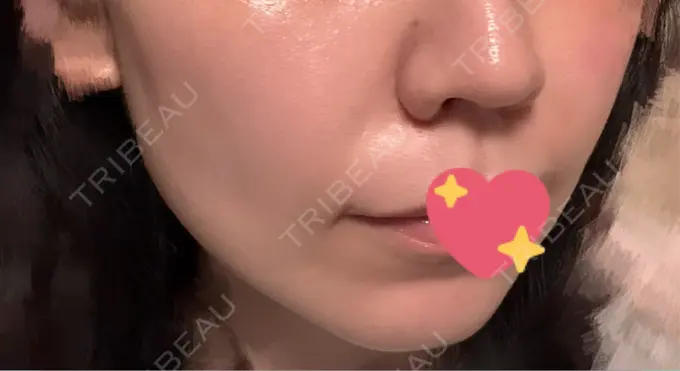 ヒアルロン酸注入（鼻翼基部） Brandnew Beauty Clinic DAY 7 メイン用