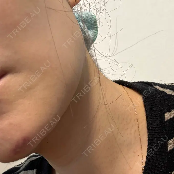 ジャルプロ エクラクリニック 大宮 DAY 3 メイン用