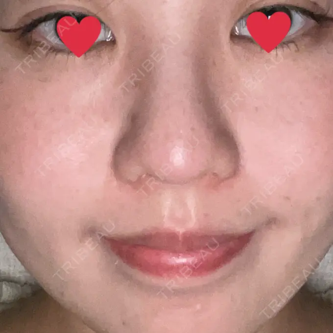 光治療（フォトフェイシャルなど） トラスト美容クリニック 銀座院 DAY 10 メイン用