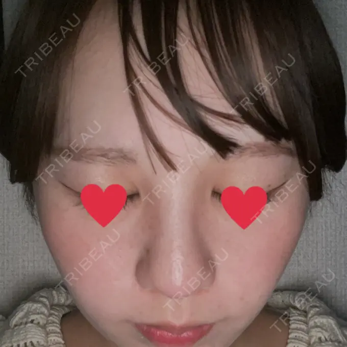 光治療（フォトフェイシャルなど） トラスト美容クリニック 銀座院 AFTER メイン用