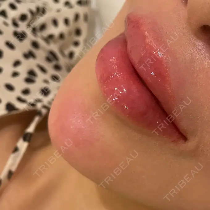 ヒアルロン酸注入（涙袋） / ヒアルロン酸注入（あご） / ヒアルロン酸注入（唇） 麻布十番クレールデンタルクリニック DAY 0 メイン用