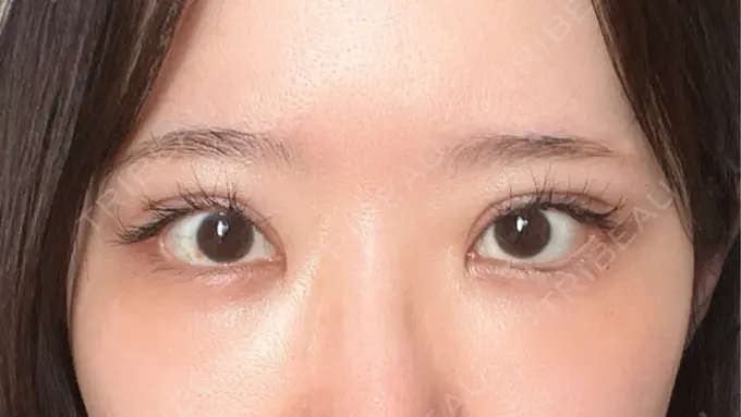 クマ治療 / 下まぶたの脂肪取り / 脂肪注入（目の下） ルラ美容クリニック 渋谷本院 DAY 10 メイン用