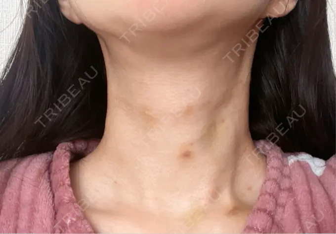 ヒアルロン酸注入（首） 銀座TSUBAKIクリニック DAY 3 メイン用