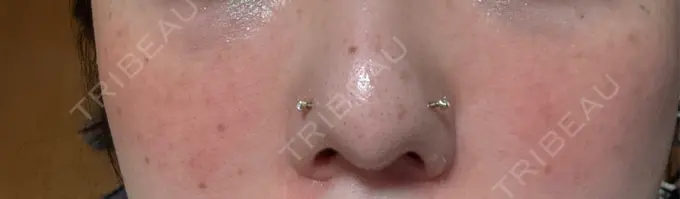 マイクロボトックス Natural Skin Clinic 自由ヶ丘院 DAY 4 メイン用