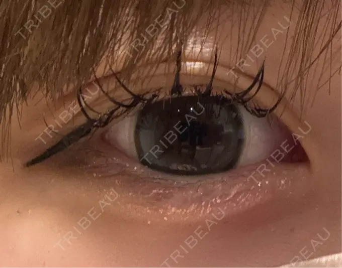 ヒアルロン酸注入（涙袋） フィラークリニック 名古屋栄院 DAY 0 メイン用