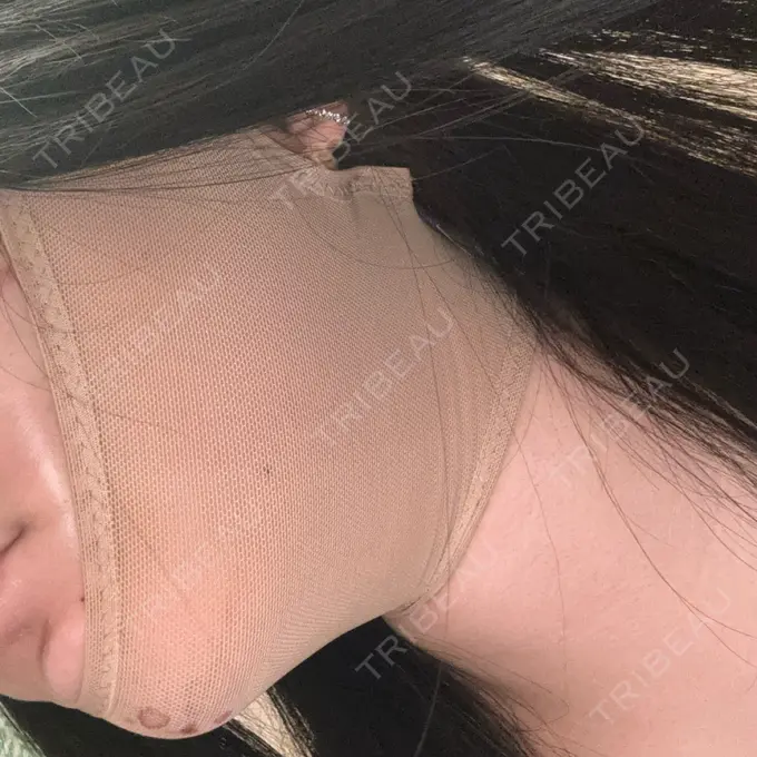 糸リフト / バッカルファット除去 / 脂肪吸引（顔） / ボトックス（エラ・小顔） アリエル美容クリニック 横浜院 DAY 1 メイン用