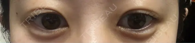 ヒアルロン酸注入（涙袋） フィラークリニック 名古屋栄院 DAY 3 メイン用