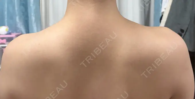 ボトックス（肩） / ワキ汗治療（ボトックス） DMTC CLINIC 渋谷院 AFTER メイン用