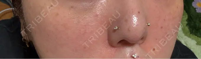 マイクロボトックス Natural Skin Clinic 自由ヶ丘院 DAY 5 メイン用