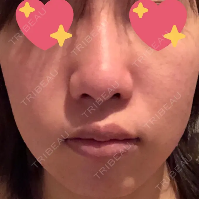 糸リフト / バッカルファット除去 湘南美容クリニック 高松院 DAY 1 メイン用