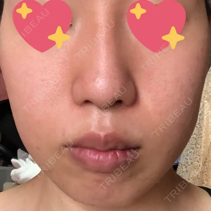 糸リフト / バッカルファット除去 湘南美容クリニック 高松院 DAY 7 メイン用