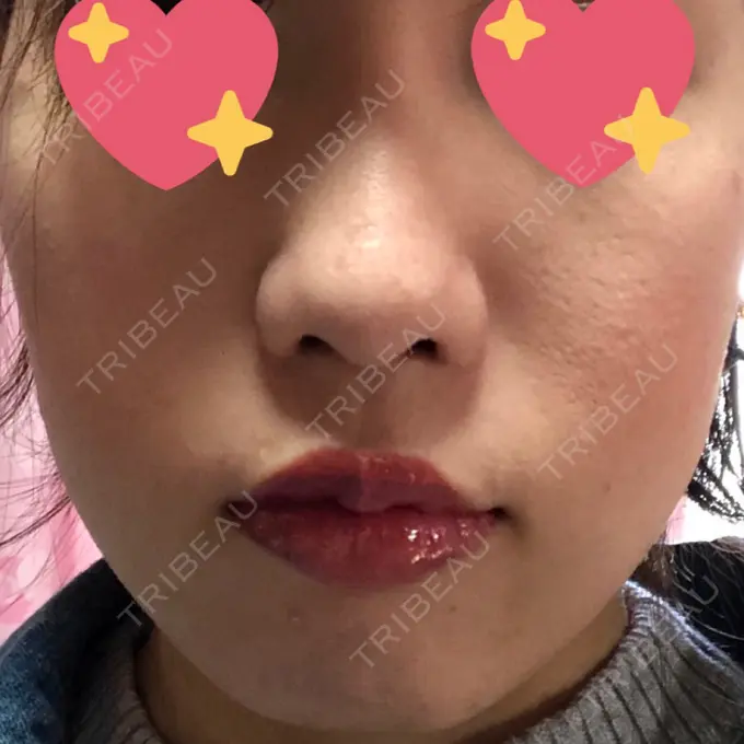 糸リフト / バッカルファット除去 湘南美容クリニック 高松院 DAY 10 メイン用