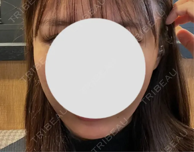 糸リフト / その他（肌） MAクリニック 心斎橋 AFTER メイン用