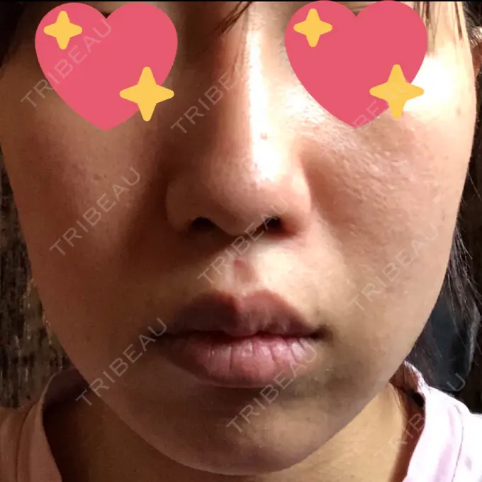 糸リフト / バッカルファット除去 湘南美容クリニック 高松院 DAY 18 メイン用