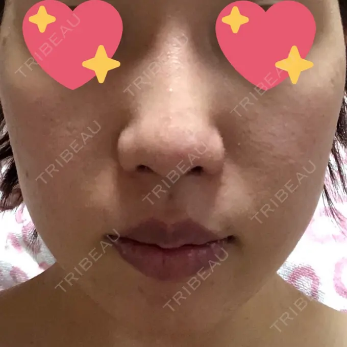 糸リフト / バッカルファット除去 湘南美容クリニック 高松院 DAY 30 メイン用