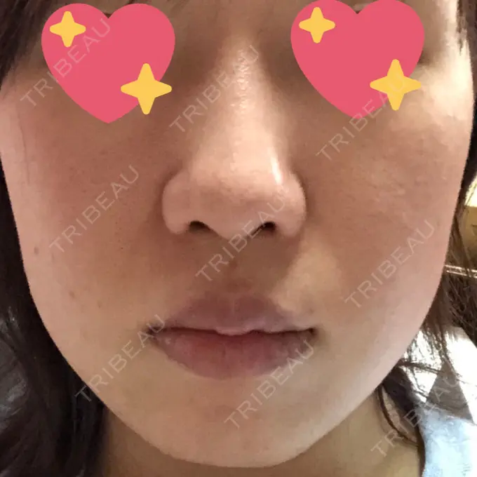 糸リフト / バッカルファット除去 湘南美容クリニック 高松院 DAY 37 メイン用